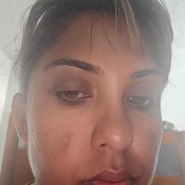 Melasma before and after: SHIFAH customer face with patchy pigmentation, then a more even tone