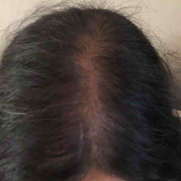 Haircare before and after: thinning at the crown, then fuller-looking hair after a month of SHIFAH rice water care