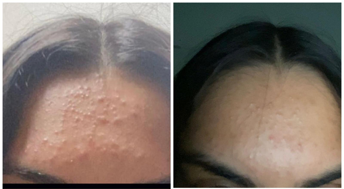 Haircare before and after: thinning parting with scalp showing, then fuller-looking hair at the parting with SHIFAH rice water care