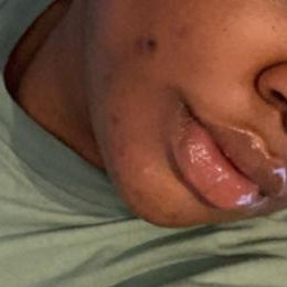 Skincare before and after: close-up of a cheek with spots and marks, then clearer, more even skin