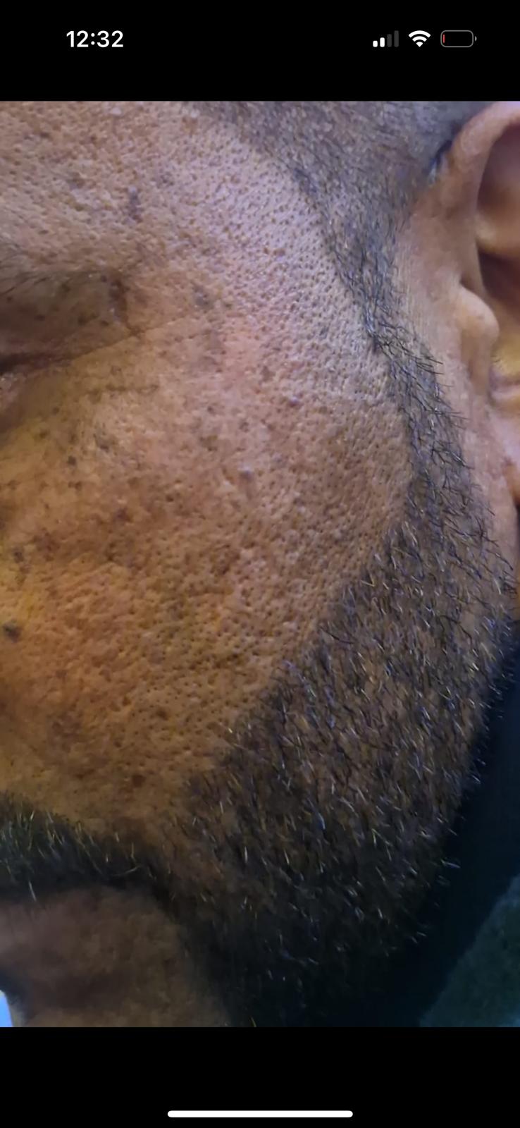 Men’s skincare before and after: close-up of a bearded cheek with uneven texture and dark spots, then smoother, more even skin