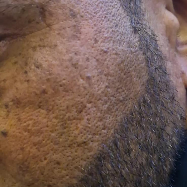 Men’s skincare before and after: close-up of a bearded cheek with uneven texture and dark spots, then smoother, more even skin