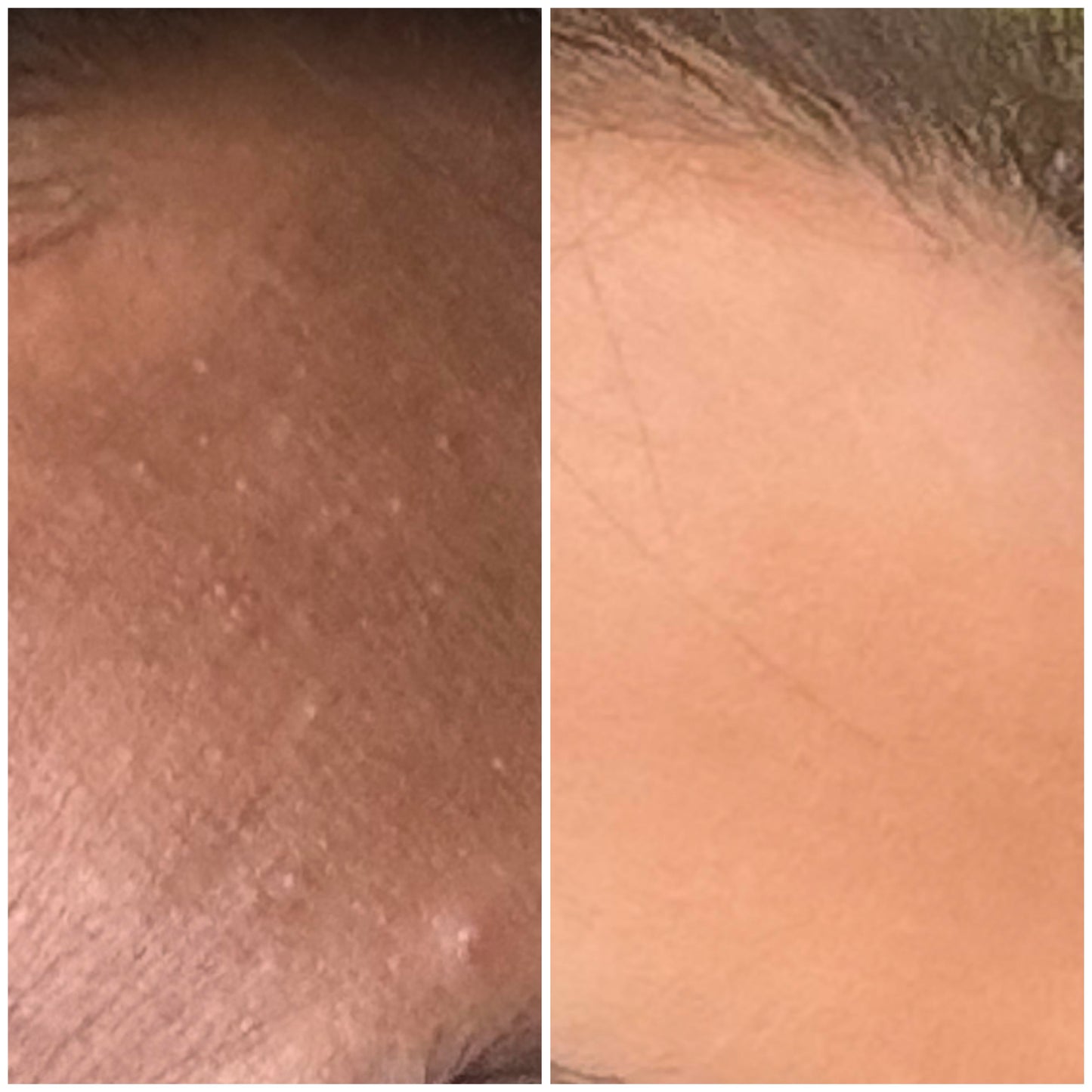Dark Spot Correcting Serum Hyperpigmentation & Acne Mark Brightening Treatment with Vitamin C, Niacinamide & Tranexamic Acid