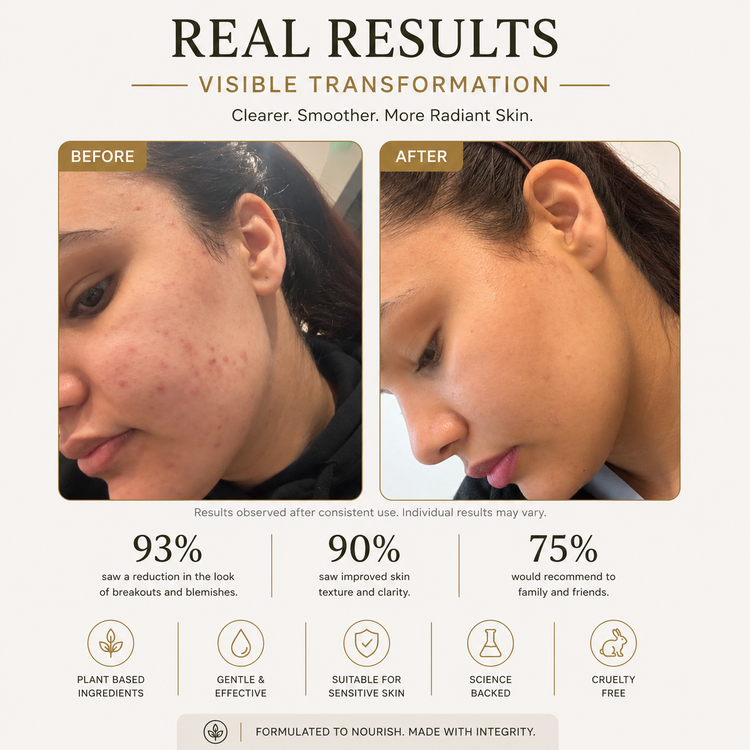 SHIFAH Acne Pimple Patches, 36 Patches