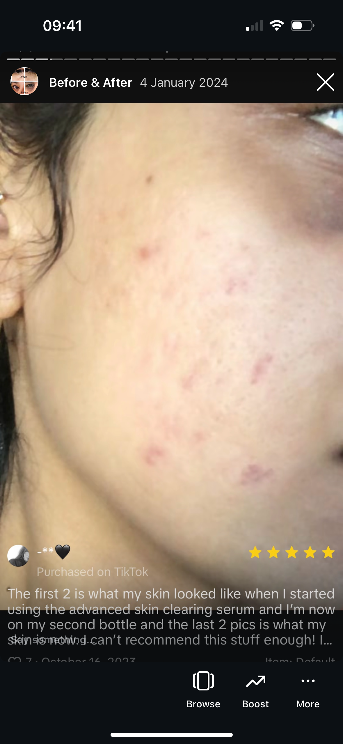 Skincare before and after: close-up of a cheek with acne, then clearer, calmer skin on her second bottle of SHIFAH serum