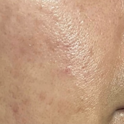 Skincare before and after: close-up of rough, uneven skin texture, then smoother skin after 3 days