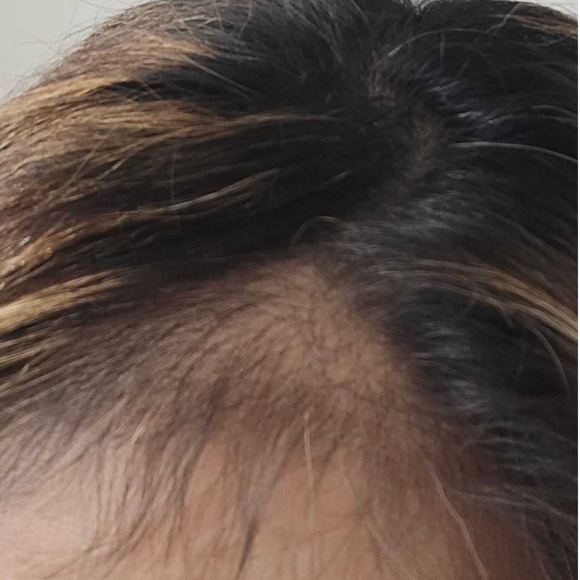 Haircare before and after: thinning hairline at week 1, then fuller-looking hair at week 4 of SHIFAH rice water care