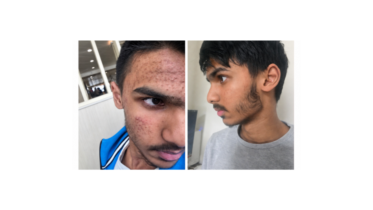 Acne skincare before and after: real SHIFAH customer with clearer skin