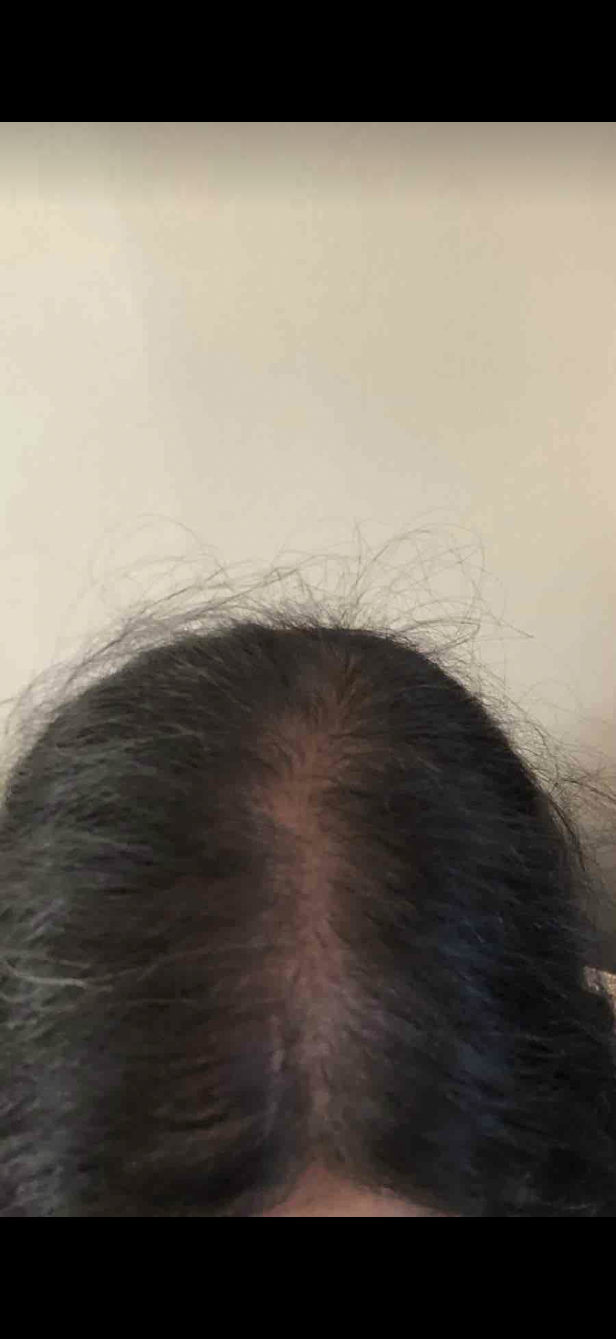 Haircare before and after: thinning at the crown, then fuller-looking hair after a month of SHIFAH rice water care