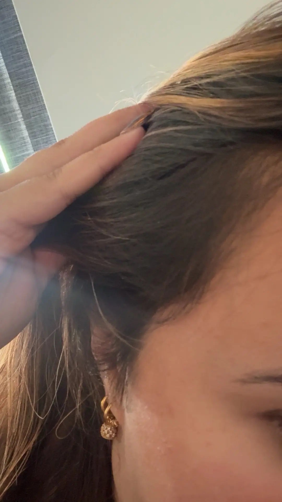 Haircare before and after: thinning hairline at the temple, then fuller-looking hairline with SHIFAH rice water care