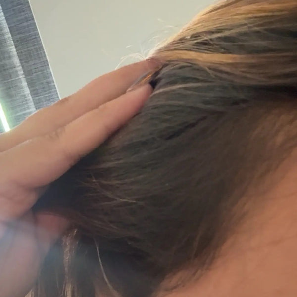 Haircare before and after: thinning hairline at the temple, then fuller-looking hairline with SHIFAH rice water care