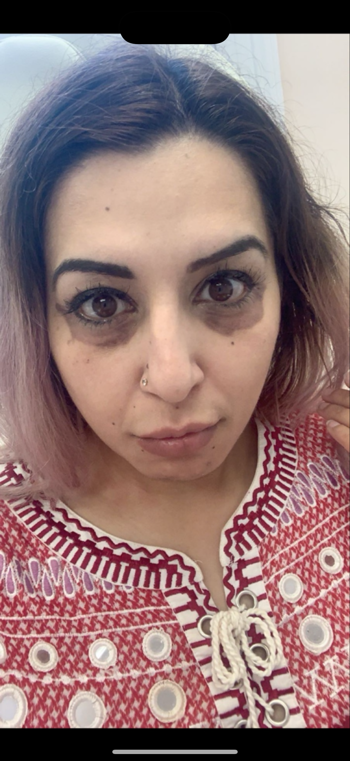Farnaz Khan with dark burn marks around her eyes after a laser treatment