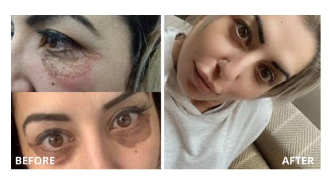 Dark circles before and after: real SHIFAH customer under-eye result