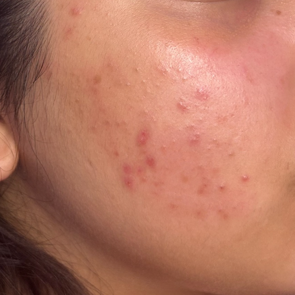 Skincare before and after: close-up of a young girl’s cheek with acne and red marks, then clear, calm skin