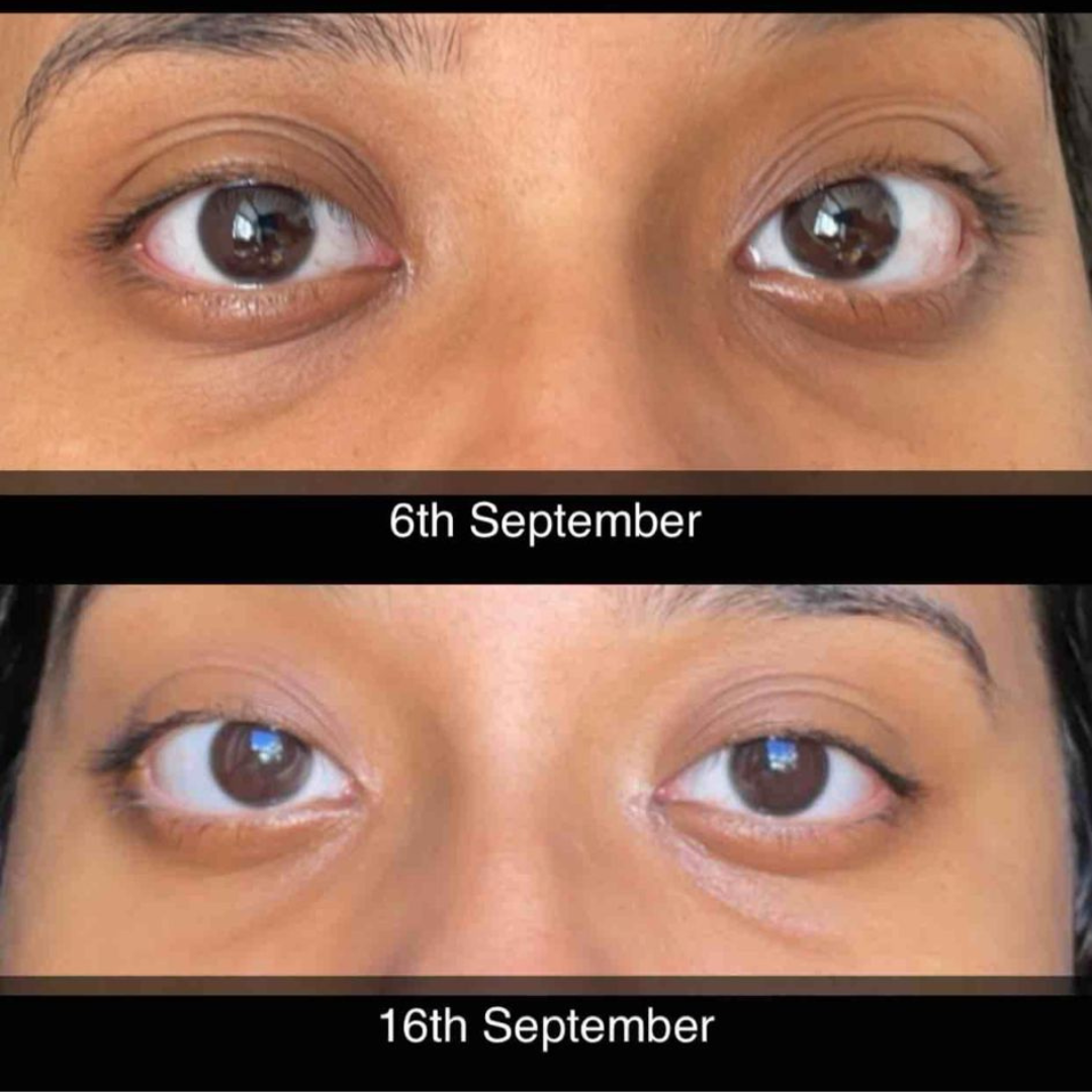 SXCglo Kojic Acid Soap + FREE Soap Tin