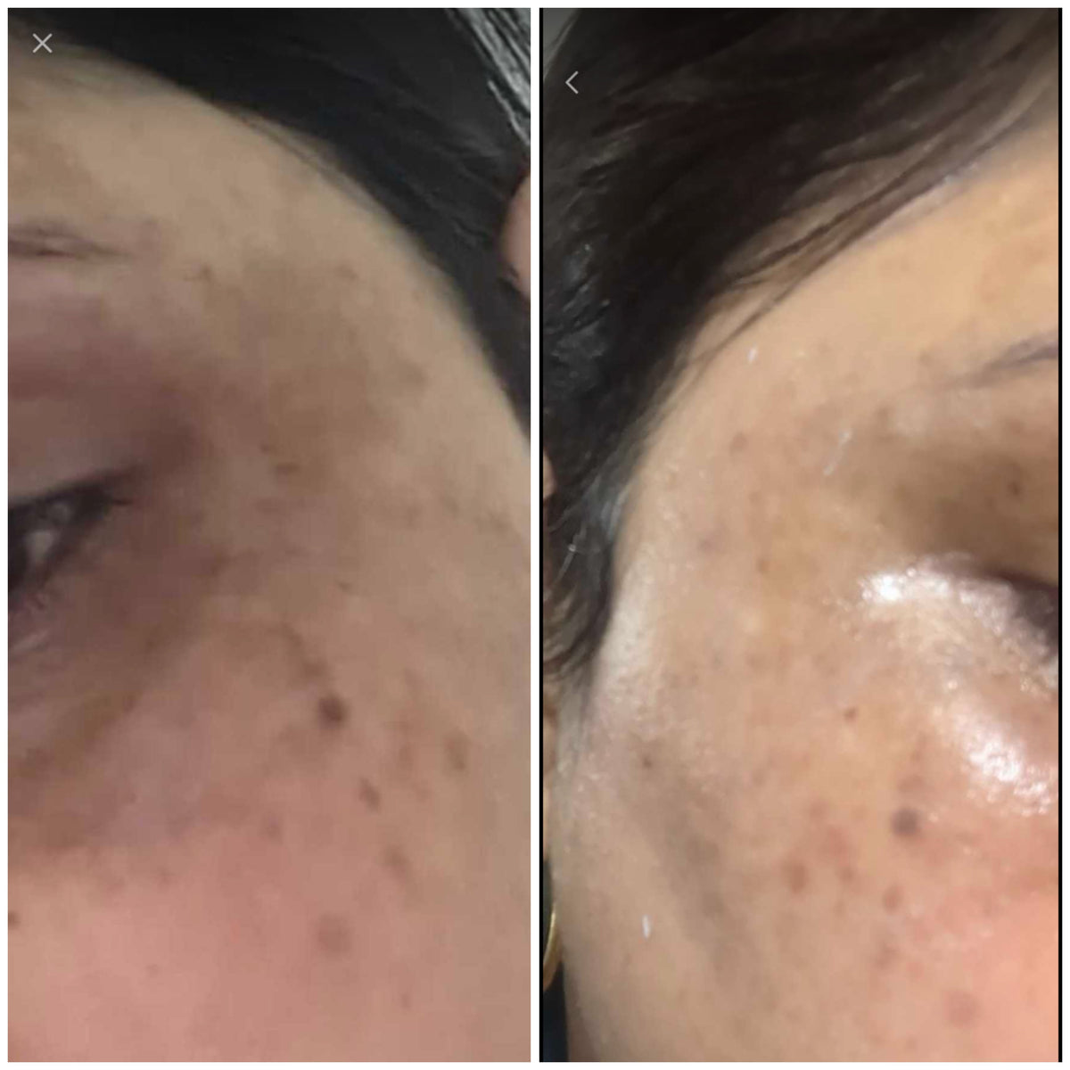 Dark spots skincare before and after: real SHIFAH customer result