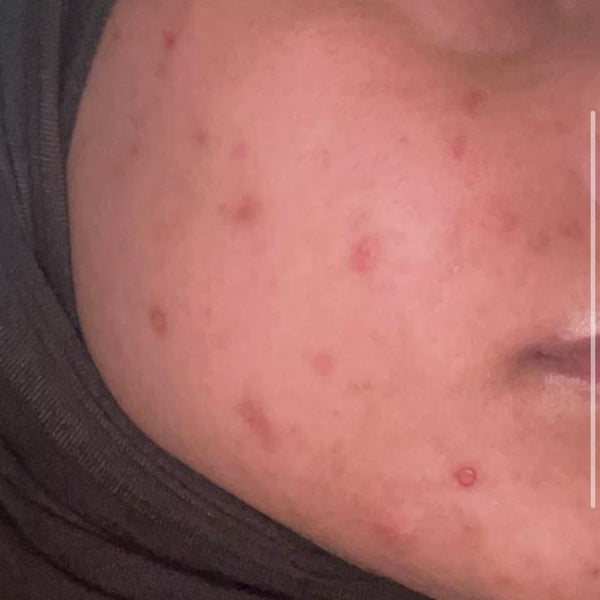 Skincare before and after: close-up of a cheek with dark spots, then lighter, more even skin with no makeup or filters